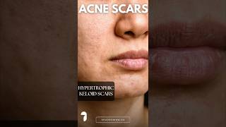 Types Of Acne Scars  HypertrophicKeloid Scars [upl. by Eiramlirpa]