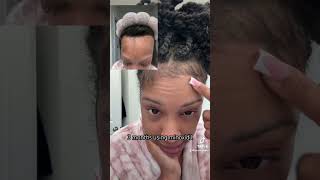 3 months using Minoxidil 💕 alopecia minoxidil hairlosstreatment alopeciahairloss walmart [upl. by Nikola]