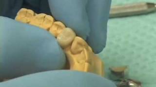 Fabricating Provisional Crowns [upl. by Alroi]