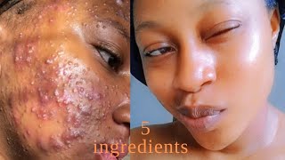 my skincare routine for acne amp scars finally [upl. by Rebbecca]