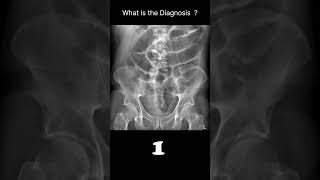 Postoperative ileus Abdominal Xray Abnormalities Postoperative ileus 66 radiologychannel007 [upl. by Daza41]