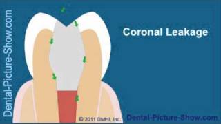 Root canal treatment complications Coronal Leakage [upl. by Maltz783]