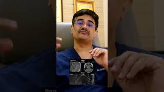 Tumors of the Spinal bones Treatment options  DrRoopesh Kumar [upl. by Abroms]