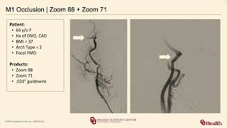 Dr Hakeem Shakir  A Minimalist Approach to Stroke Simple Fast Effective [upl. by Chalmer]