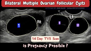 TVS Ultrasound  Bilateral multiple Ovarian Follicular Cysts [upl. by Ruphina864]