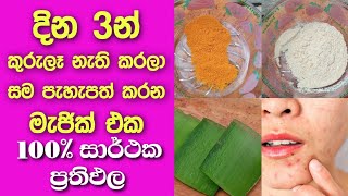 දින 3න් කුරුලෑ සුව කරන මැජික් එක  Kurule walata Beheth  Pimple treatment sinhala [upl. by Naedan303]