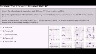 ECG 10 esercizi molto difficili sullinfarto [upl. by Ilegna]