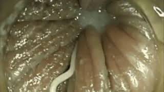 Enterobius vermicularisPinworm Infection [upl. by Urbanus]