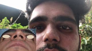 How To Reshape Nose Bone Naturally  Get Sharp and Straight Nose in 14 minutes [upl. by Kcira929]