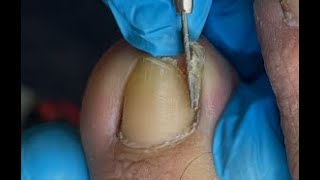 Huge ingrown toenail removal [upl. by Adnaluoy532]