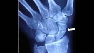 Scaphoid Fracture Diagnosis and Treatment COMLEX USMLE [upl. by Yemarej]