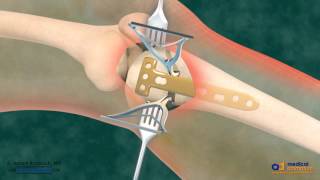 High Tibial Osteotomy HTO for Bow Leg Correction [upl. by Travus216]