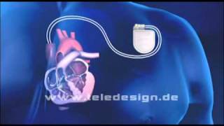 HGL 020 Schrittmacher Zweikammer  PAL 169 HGL 020 Biventricular pacemaker  PAL 169 [upl. by Eniamerej]