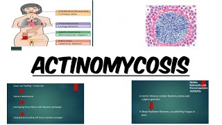 ACTINOMYCOSIS  IMAGES  MCQs [upl. by Otrevlig551]