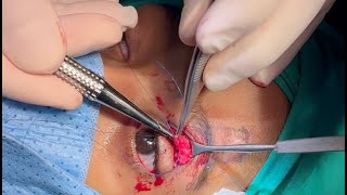 Frontalis Flap for Ptosis Repair [upl. by Enalb]