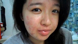 My Acne Story 15th Week of Accutane [upl. by Houston]