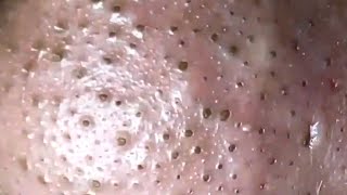 Blackheads amp Whiteheads Satisfying Removal 0004 [upl. by Kahler]