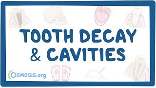 Tooth decay and cavities  causes symptoms diagnosis treatment pathology [upl. by Euqinmod658]