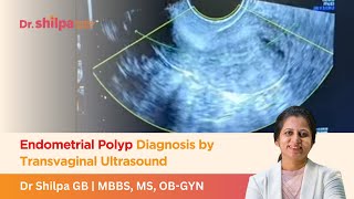 Endometrial Polyp Diagnosis by Transvaginal Ultrasound  Dr Shilpa G B [upl. by Sandie203]