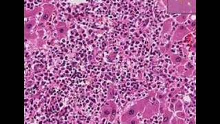 Histopathology LiverAcute myeloid leukemia [upl. by Kosak839]