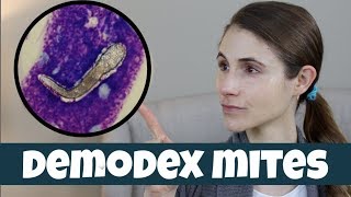 DEMODEX MITES ON YOUR SKIN DR DRAY [upl. by Darlene]