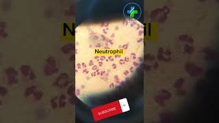 High neutrophil count in peripheral smear  neutrophils  CBC  Causes of Neutrophilia  hematology [upl. by Cletus]