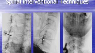 Radiology  Radiological Spine Interventions [upl. by Weber]