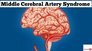 Middle Cerebral Artery SyndromeMiddle Cerebral Artery StrokeZeenad Learning Hub [upl. by Hanimay]