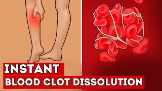 These 7 FOODS Instantly Dissolve Blood Clots in Your Vessels [upl. by Wylde]