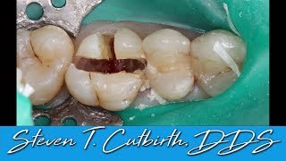 Sectioning and Extraction of Maxilary First Molar  with Steven T Cutbirth DDS [upl. by Cyrillus]