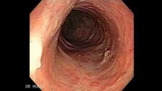 Colonoscopy of Ulcerative Colitis [upl. by Adnowal880]