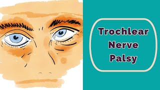 Trochlear Nerve Palsy Rapid Review [upl. by Nnaynaffit]