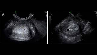 SACO GESTACIONAL ULTRASONIDO ecografia saco gestacional EMBARAZO PRIMER TRIMESTRE [upl. by Wendi]