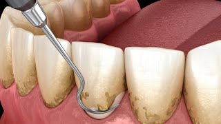 PERIODONCIA TRATAMIENTO DE ENFERMEDADES QUE PUEDEN CAUSAR PÉRDIDA DE DIENTES  EL DOCTOR EN CASA TV [upl. by Anitsihc]