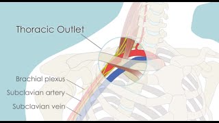 Transaxillary First Rib Resection for Thoracic Outlet Syndrome TOS [upl. by Lanor]