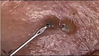 Severe Eye Blackhead Removal  Acne Cystic Treatment Spa  Pimple Popping Elderly Acne Remove  056 [upl. by Norrahc]