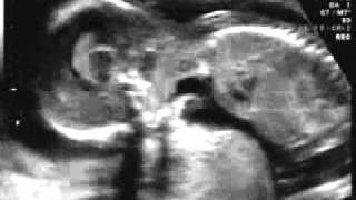 16 weeks pregnant ultrasound sonogram [upl. by Sternberg524]