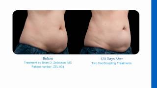 CoolSculpting Slides Irvine CA [upl. by Odlamur86]