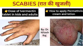 Scabies infection खाज treatment and Head lice जू treatment by Dr Nitesh Raj [upl. by Nutter]