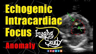 Fetal Echogenic Intracardiac Focus  Ultrasound  Anomaly  Case 261 [upl. by Ecyal]