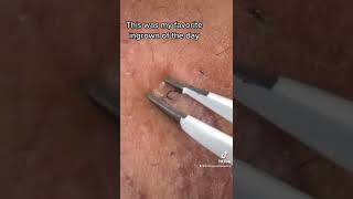 Satisfying Beard Ingrown Hair Removal [upl. by Eanehs]