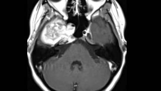 Chondrosarcoma [upl. by Lednam]