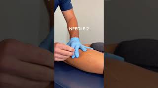 DRY NEEDLING CALF THERAPY 🦵😁💉 [upl. by Atok]