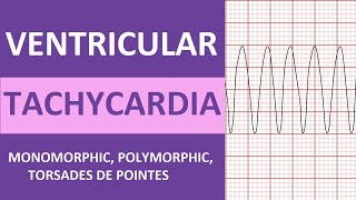 Ventricular Tachycardia Vtach ECG Interpretation Treatment Nursing NCLEX Review [upl. by Selima865]