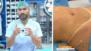 Laser Liposuction Procedure [upl. by Enidaj]