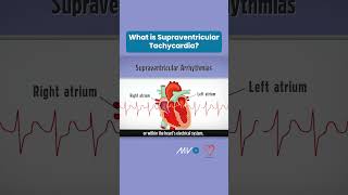 What is Supraventricular Tachycardia [upl. by Anyar767]