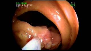 Using Capsule Endoscopy and Double Balloon Enteroscopy for Complex Small Intestinal Disease [upl. by Damon]