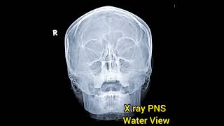 X Ray PNSWater ViewParanasal Sinus shortsvideo [upl. by Berns424]