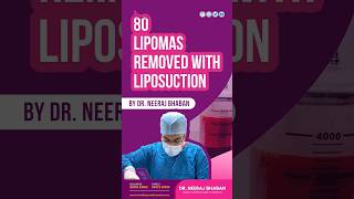 80 Lipoma Removal with Liposuction Liposuctionexcision lipomaremoval surgery cosmeticsurgery [upl. by Mei]