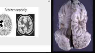 Schizencephaly presentation [upl. by Garda]